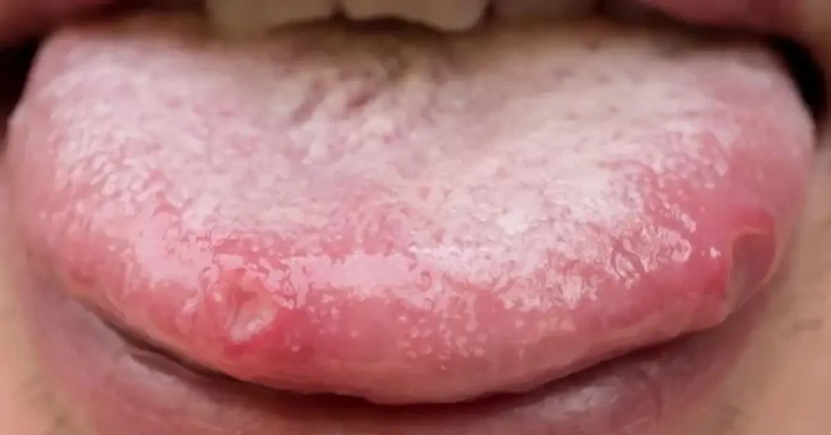 Genç Gazete Dilinizde Geçmeyen Yara Mı Var Ağrıyor, Yanıyorsa Dikkat! Dil Ülseri Nedir, Neden Olur Ve Nasıl Geçer 2