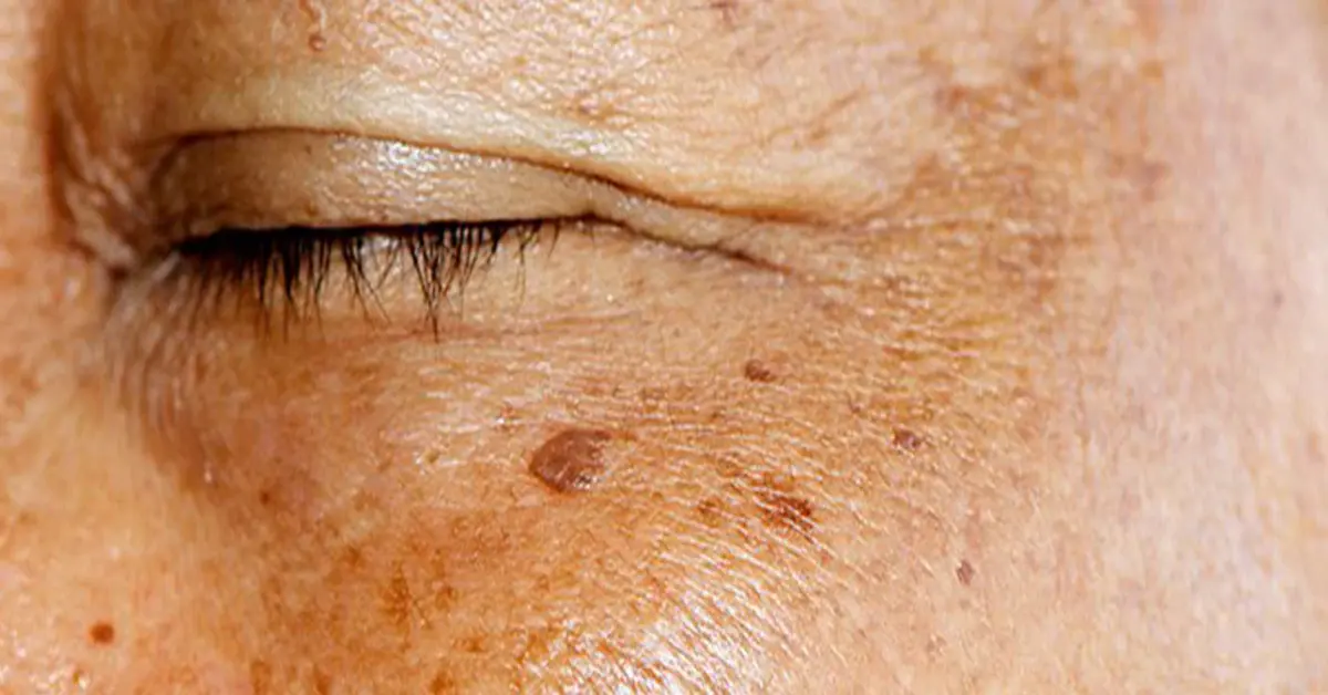 Genç Gazete Lekeli Cilt Sorunu Mu Yaşıyorsunuz Bu Hatalardan Kaçının, Cildinizi Koruyun! 2