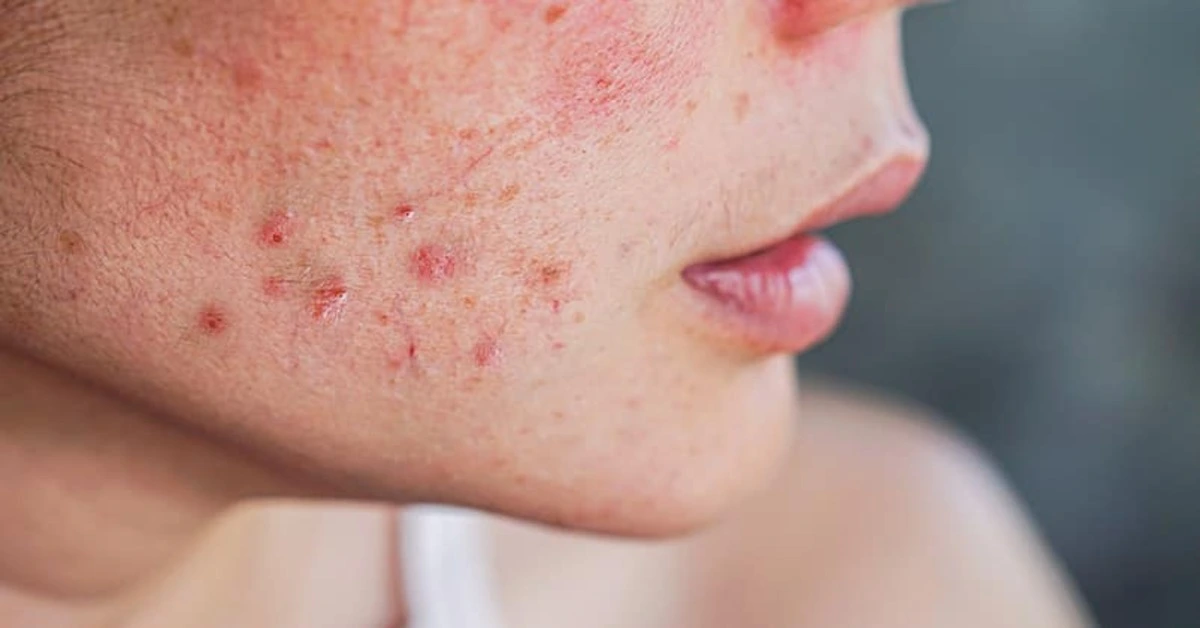 Genç Gazete Lekeli Cilt Sorunu Mu Yaşıyorsunuz Bu Hatalardan Kaçının, Cildinizi Koruyun!