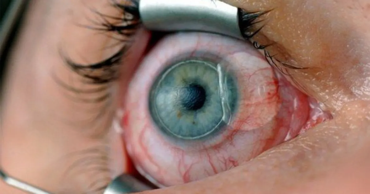 Göz Çizdirme Ameliyatı Gencgazete