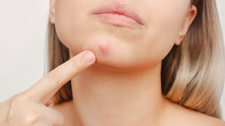 Kistik Sivilce Nedir Ve Nasıl Geçer Cilt Sağlığını Etkileyen Bu Sorunun Çözüm Yolları Neler (1)-1