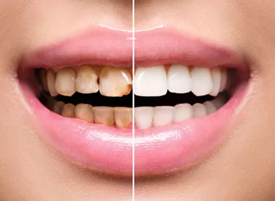 Restoratif Diş Tedavisi Nedir, Hangi Durumlarda Uygulanır Ve Kimler İçin Önemlidir (1)