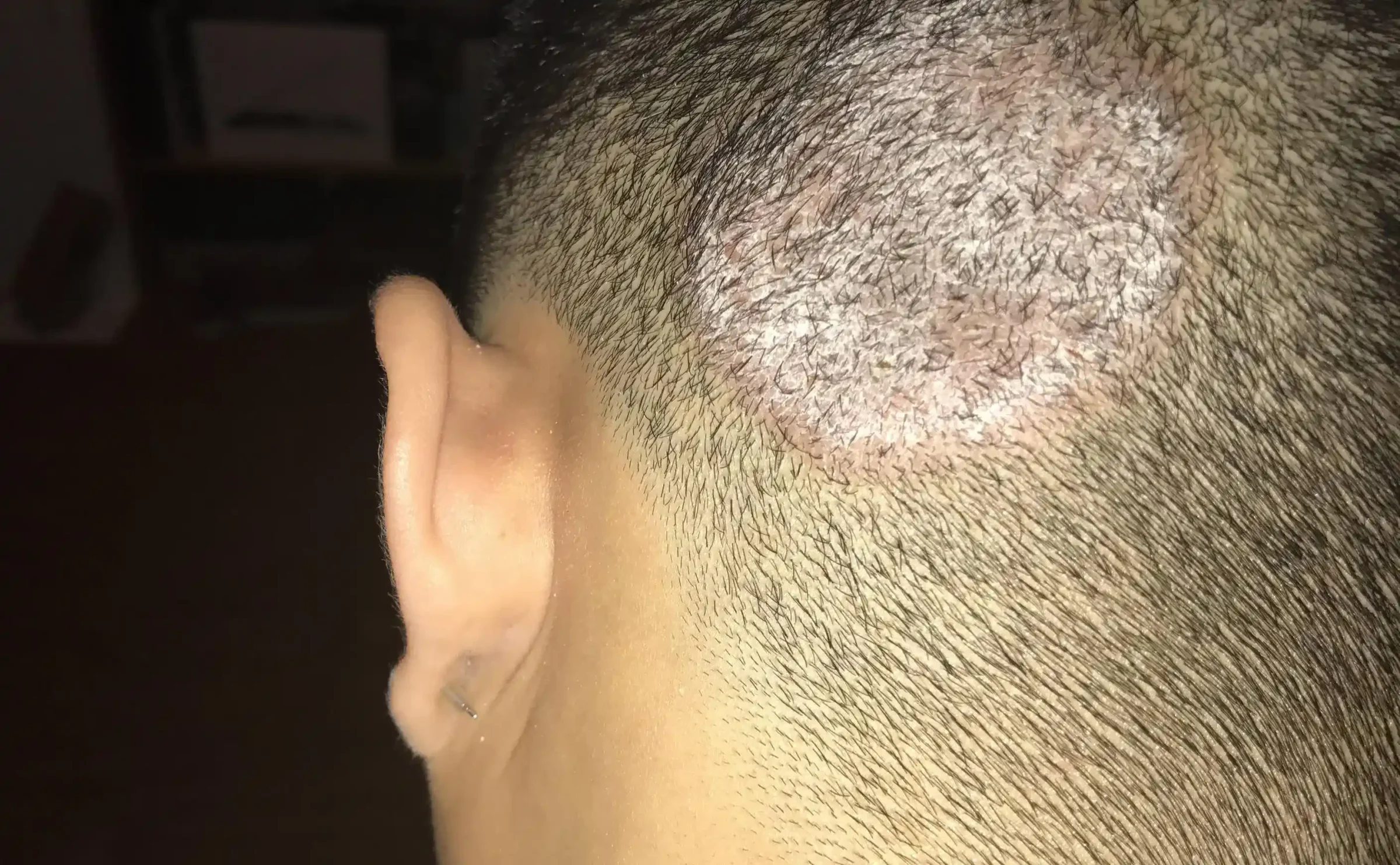 Tinea Kapitis Bas Mantari 2400X1483