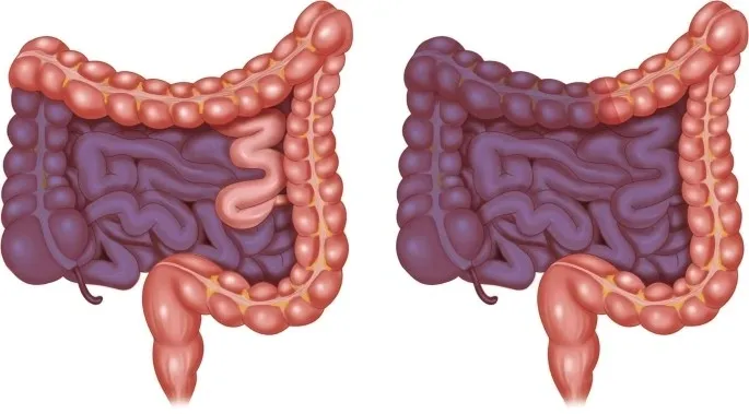 Intestinal Iskemi