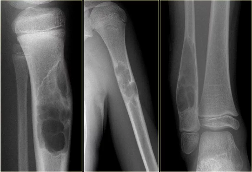 Kemik Tumoru Nedir 1