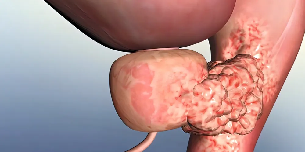 Prostat Kanseri Tedavisi