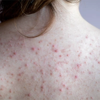 Sirttaki Sivilceler Nasil Gecer 002