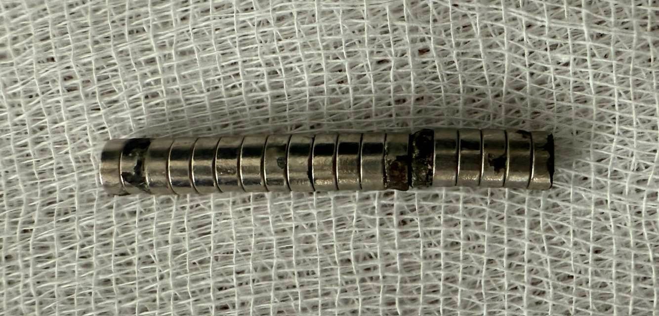 3 Yaşındaki Çocuğun Boğazından 19 Mıknatıs Gencgazete (3)