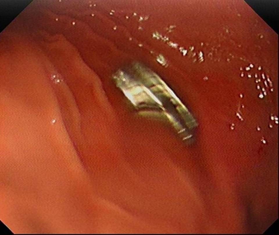 3 Yaşındaki Çocuğun Boğazından 19 Mıknatıs Gencgazete (4)