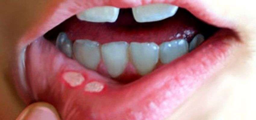 Behçet Hastalığı 25 Yaş Altı Genç Erkeklerde Daha Ağır Seyrediyor (6)