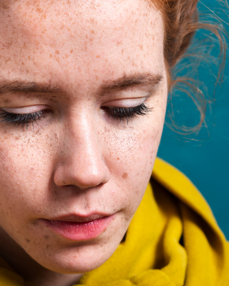 Çil Nedir, Neden Olur Ve Nasıl Geçer Gencgazete (11)