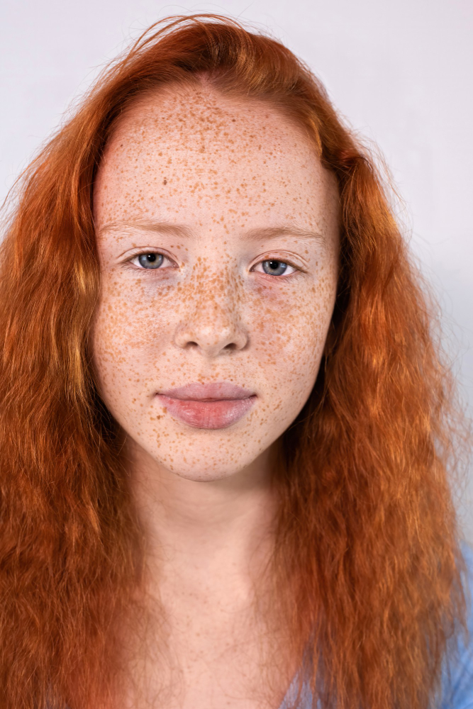 Çil Nedir, Neden Olur Ve Nasıl Geçer Gencgazete (15)