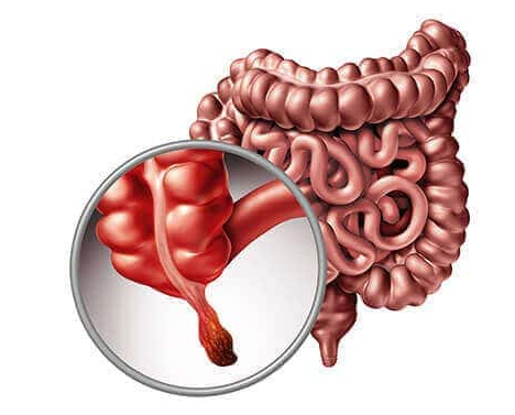 Genç Yaşlarda Apandis Kanseri Sıklığı Artıyor (1)-1