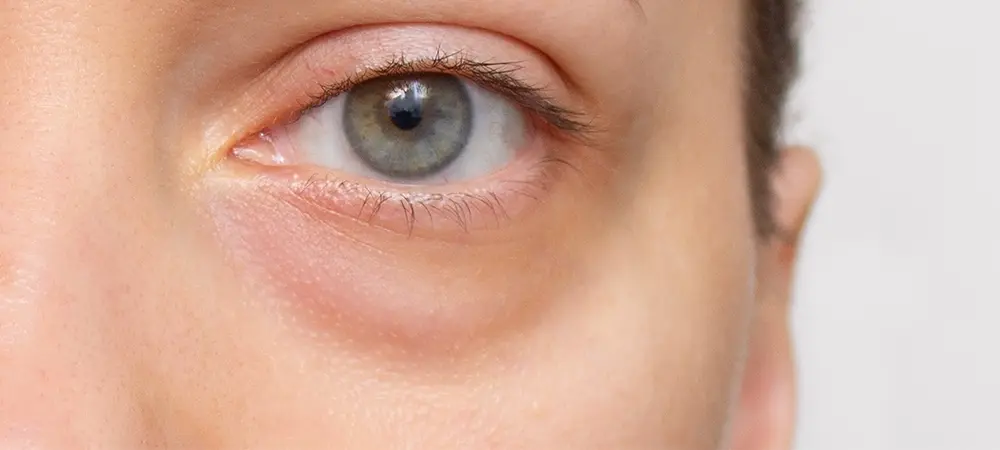 Goz Alti Torbalari 23 84776 Web Image B