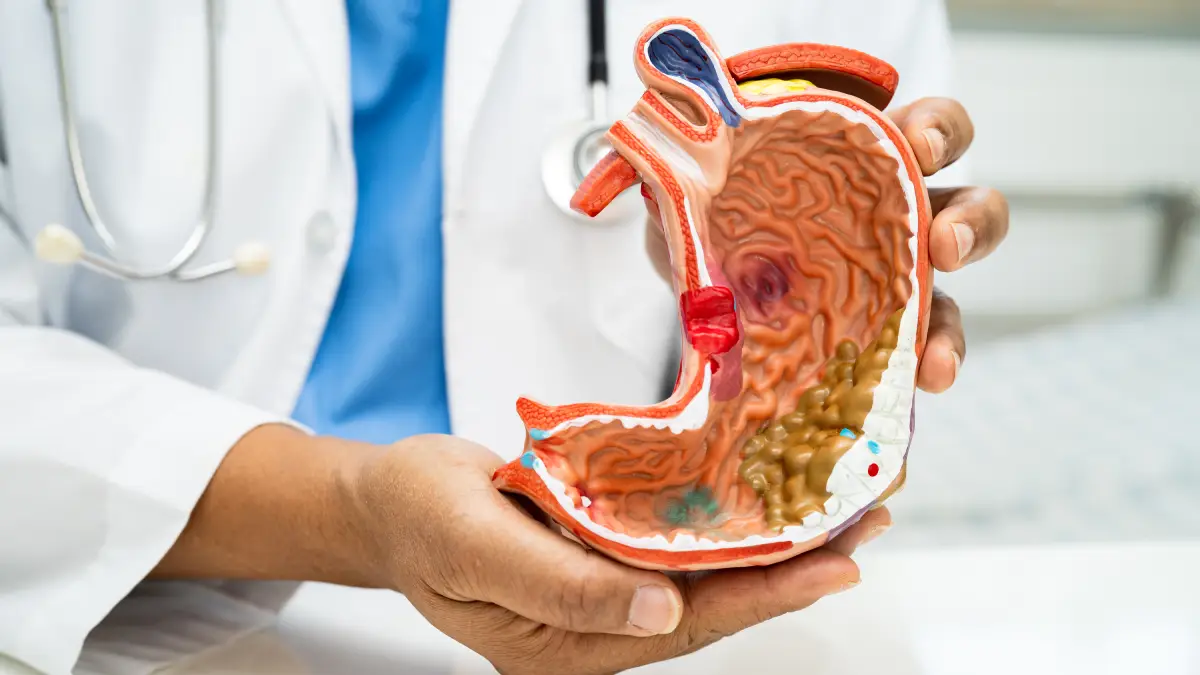 Mide Delinmesi Nedir Mide Delinmesi Belirtileri Nelerdir Ve Bu Durum Ne Kadar Tehlikelidir (1)-1