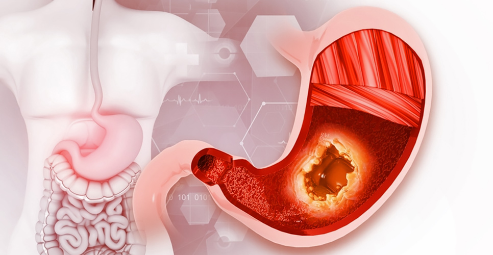 Mide Delinmesi Nedir Mide Delinmesi Belirtileri Nelerdir Ve Bu Durum Ne Kadar Tehlikelidir (1)