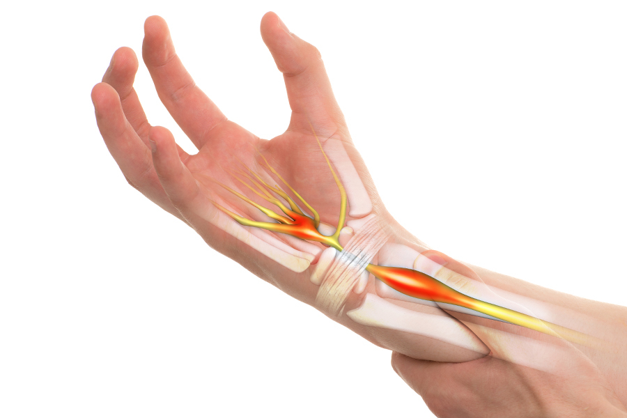 Sinir Sıkışması Nedir, Neden Olur Ve Nasıl Tedavi Edilir (2)