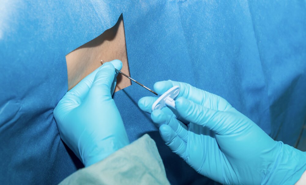 Spinal Anestezi Nedir, Hangi Durumlarda Uygulanır Ve Yan Etkileri Nelerdir?