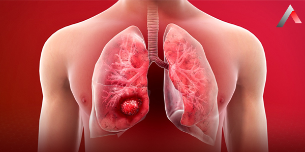 Akciğer Kanseri