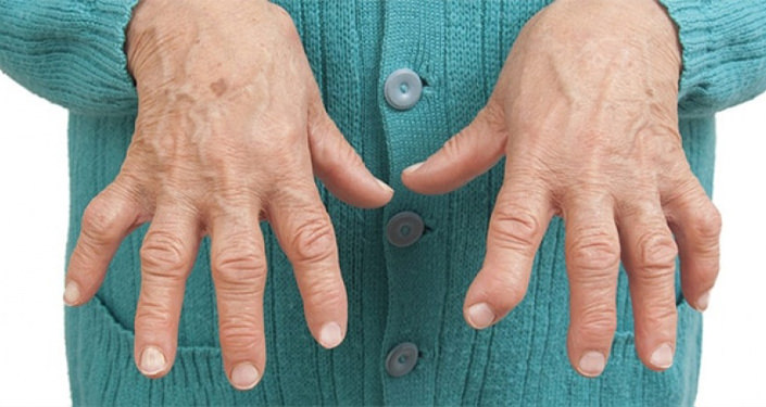 Artrit Belirtileri Hafife Alınmamalı (2)