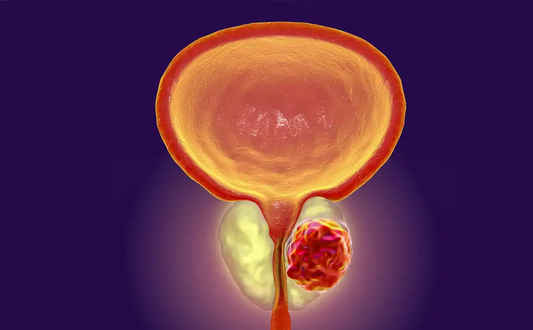 Benign Prostat Hiperplazisi