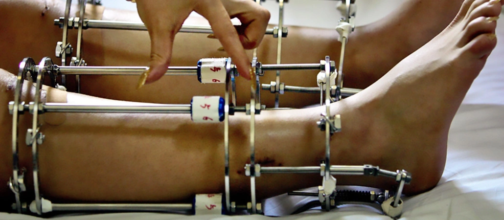 Boy Uzatma Ameliyatı-1