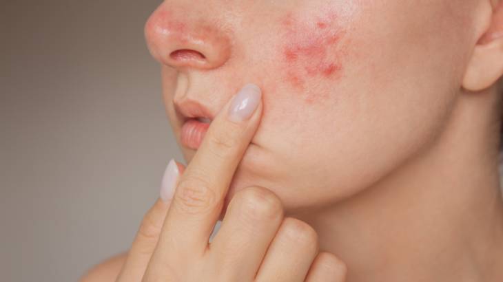 Egzama Belasını Hafifletmek İçin Denemeniz Gereken 13 Doğal Ve Etkili Malzeme Nelerdir (1)