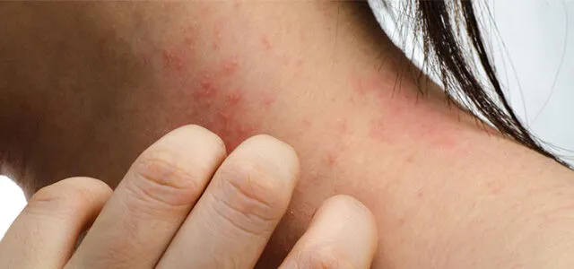 Egzama Belasını Hafifletmek İçin Denemeniz Gereken 13 Doğal Ve Etkili Malzeme Nelerdir (3)