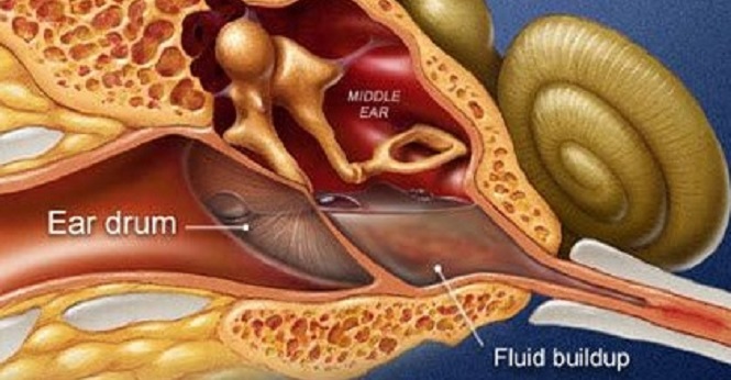 Kulakta Sıvı Birikmesi Nedir Hangi Belirtilerle Anlaşılır Ve Ne Zaman Ciddi Bir Duruma Dönüşür (2)