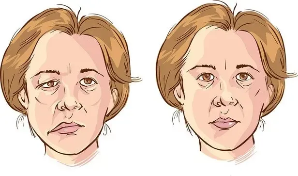 Ramsay Hunt Sendromu Nedir Yüz Felcine Yol Açabilen Bu Gizemli Hastalık Nasıl Ortaya Çıkıyor Ve Belirtileri Nelerdir (1)-2