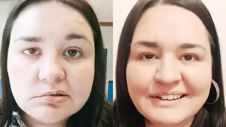 Ramsay Hunt Sendromu Nedir Yüz Felcine Yol Açabilen Bu Gizemli Hastalık Nasıl Ortaya Çıkıyor Ve Belirtileri Nelerdir (2)