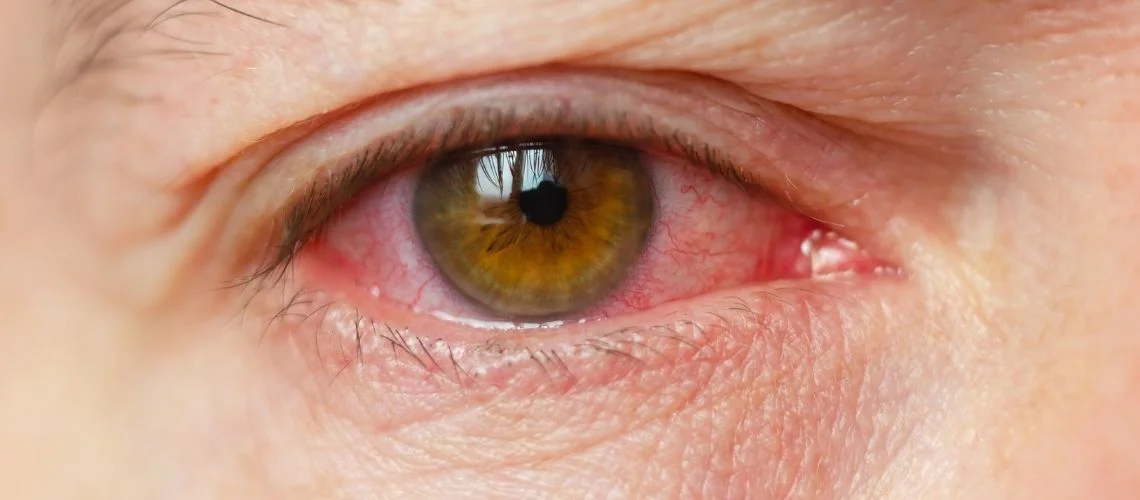 Subkonjonktival Hemoraji-1