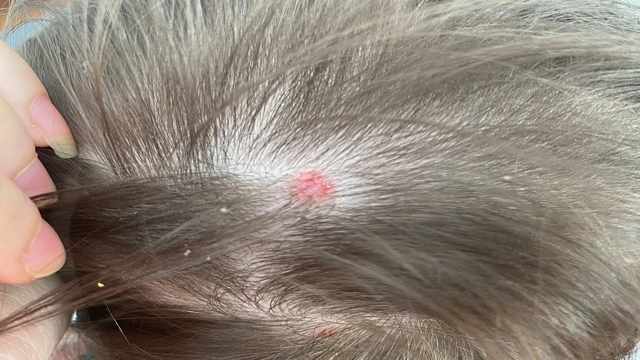 Kafada Sivilce Neden Çıkar Saç Derisinde Oluşan Bu Can Sıkıcı Sorun Nasıl Geçer Ve Tekrar Etmesi Nasıl Önlenir (2)