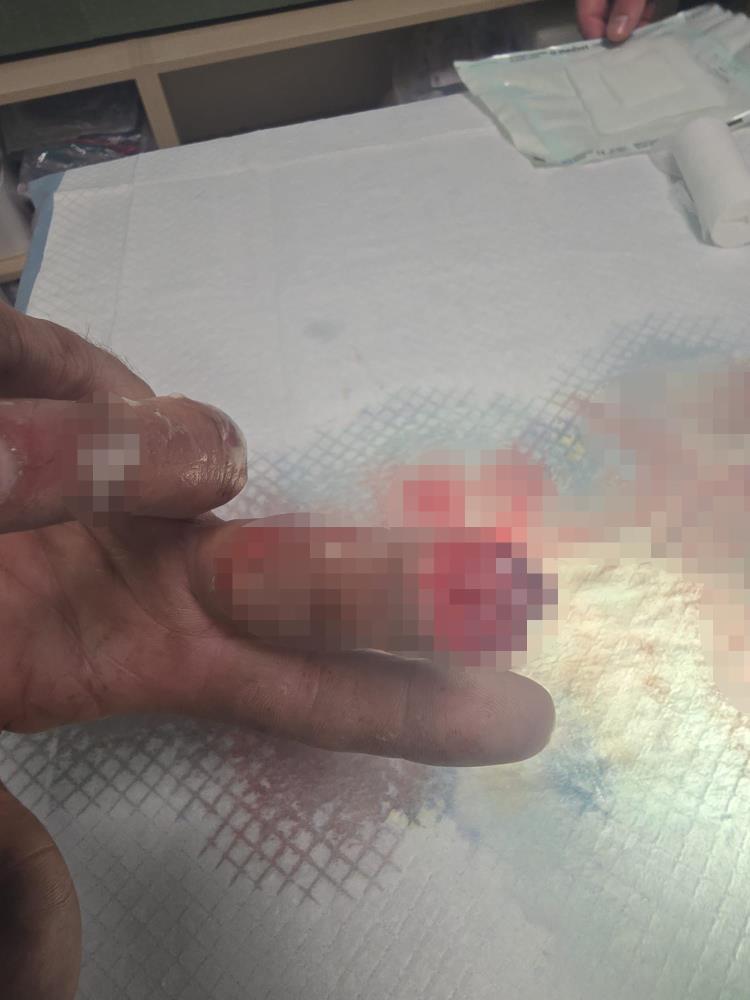 Şifayı Bursa'da Buldu! Kopan Parmağını Buz Poşetine Koyup Getirdi (3)