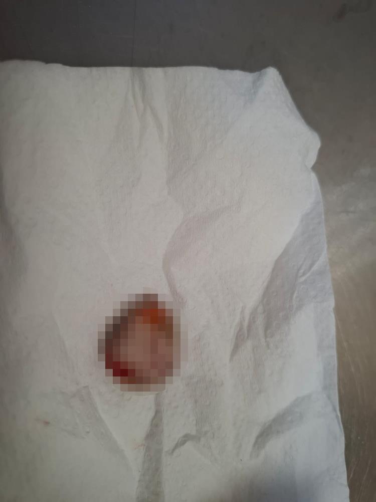 Şifayı Bursa'da Buldu! Kopan Parmağını Buz Poşetine Koyup Getirdi (4)