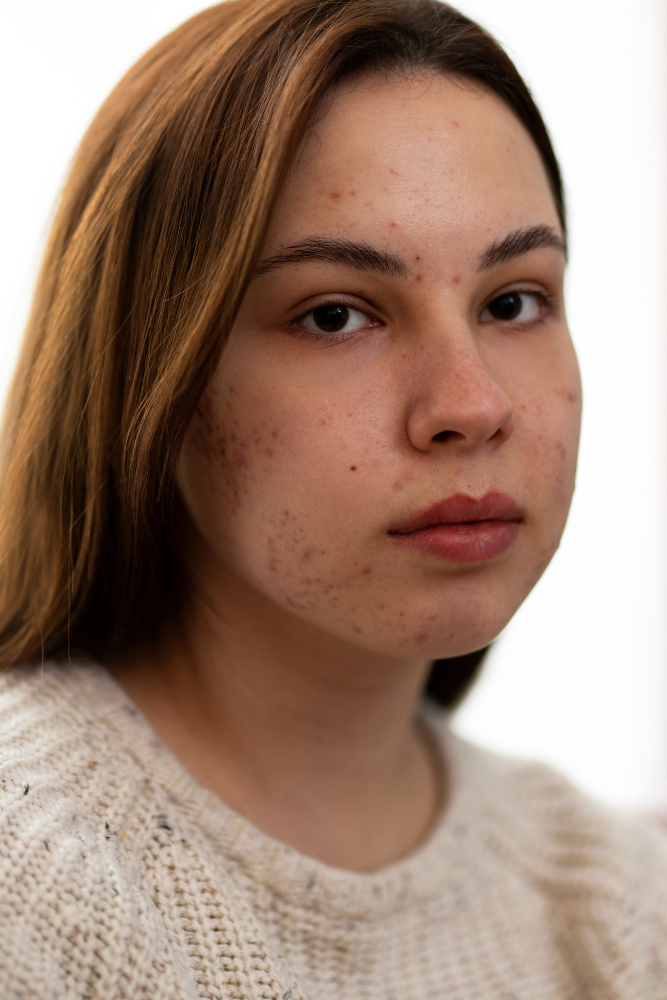 Akne Sivilce Tedavi Yöntemleri Gençgazete (8)