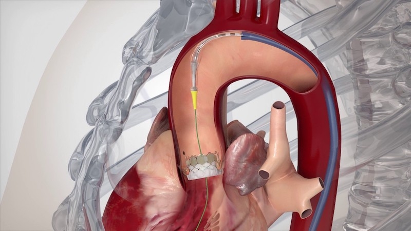 Aort Kapak Hastalıkları Nedir Kalpteki Bu Sorun Hangi Belirtilerle Ortaya Çıkıyor Ve Neden Ciddiye Alınmalı (3)