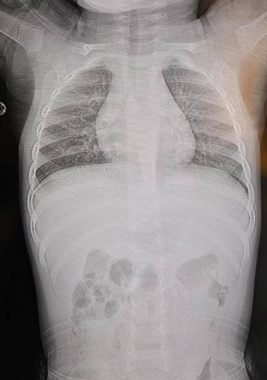 Bebeğin Sırtından Tel Parçası Çıktı F (1)