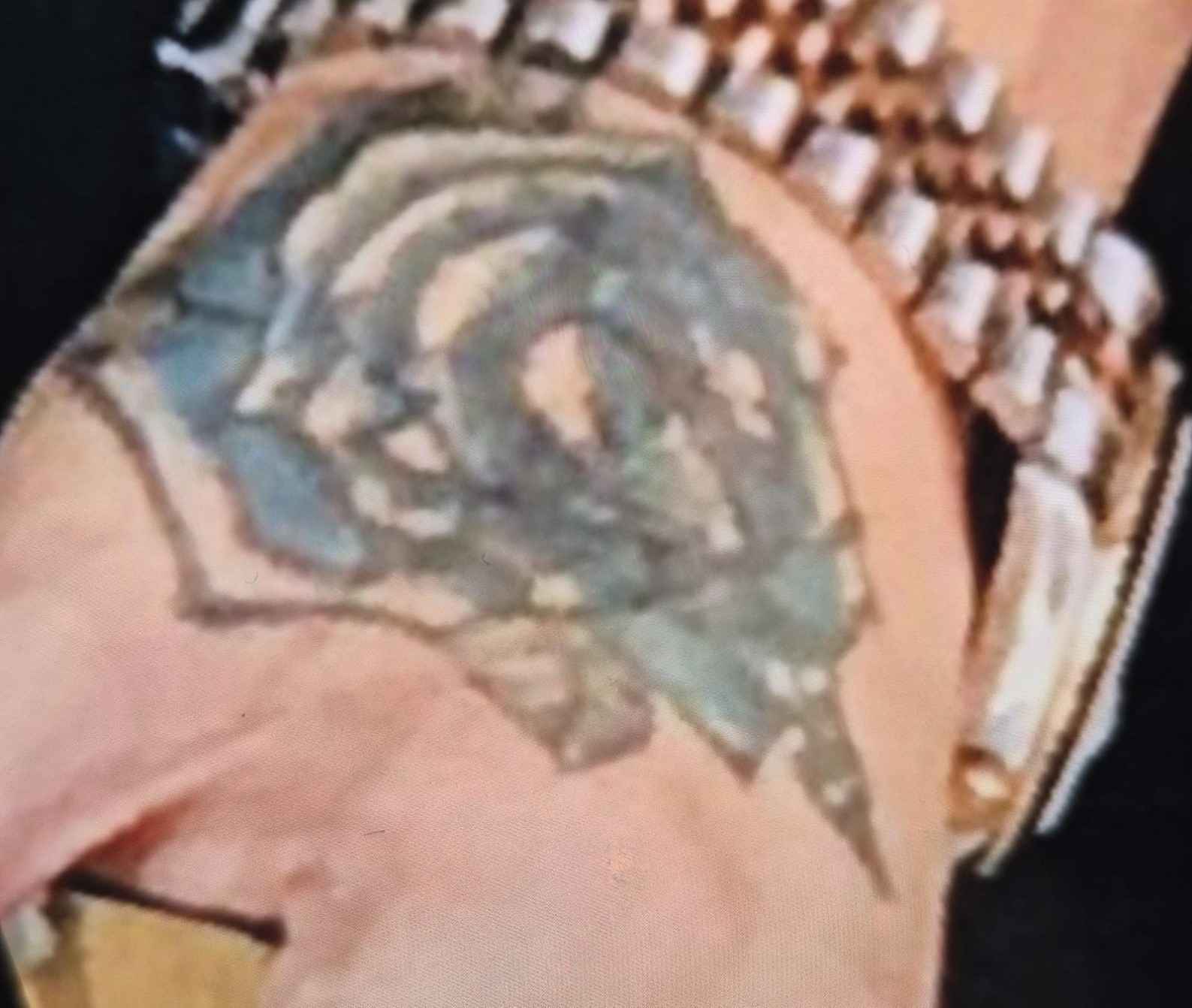 Dövme Sildirmek Isterken Kabusu Yaşadı, Elindeki Dokular Öldü (1)