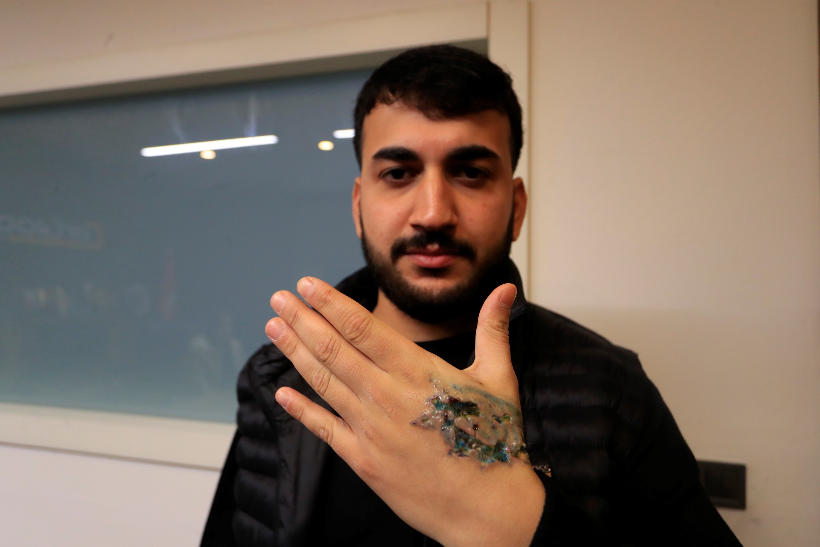 Dövme Sildirmek Isterken Kabusu Yaşadı, Elindeki Dokular Öldü (4)