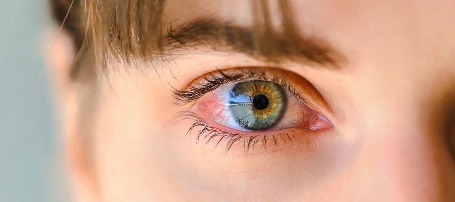 Sabahları Gözlerde Ağırlık Yerine Yanma Neden Olur (4)