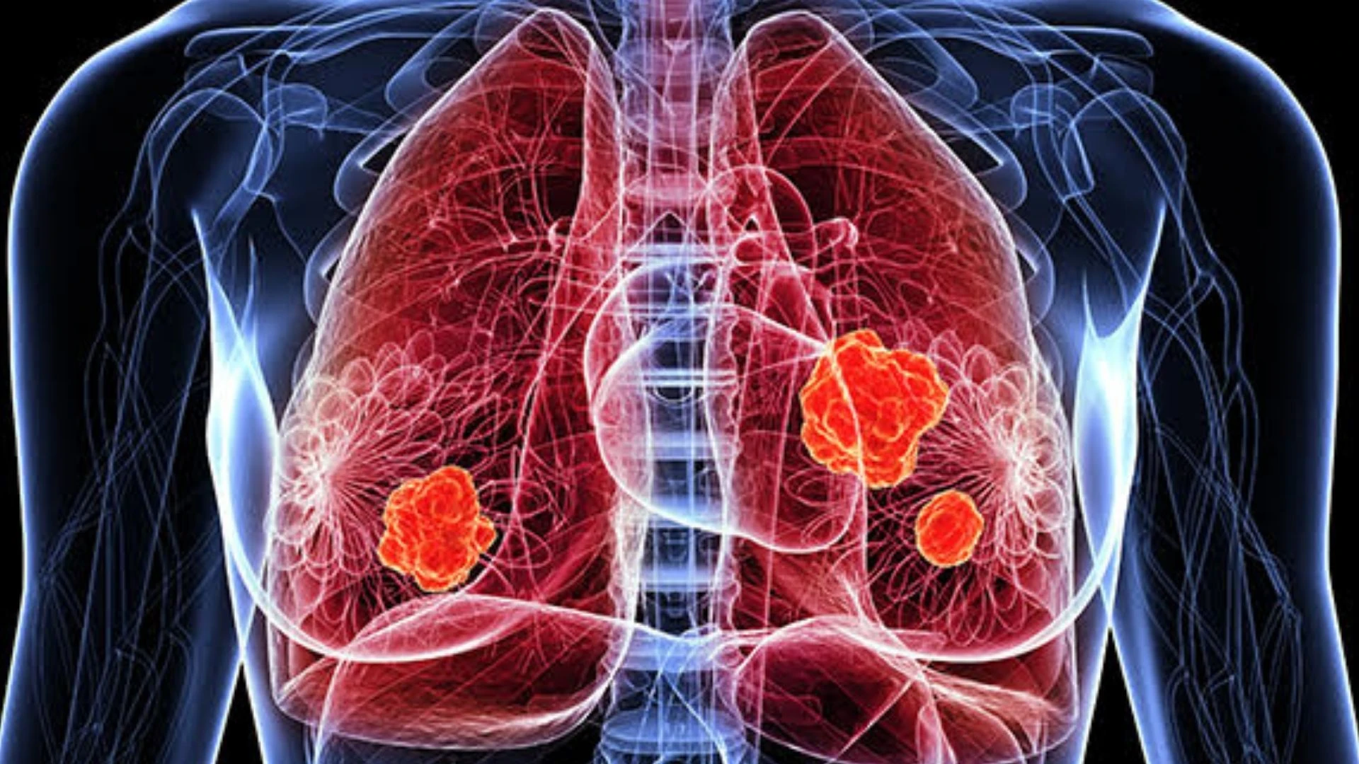 Akciğerde Su Toplaması Nedir Neden Olur Ve Hangi Belirtilerle Kendini Gösterir (1)