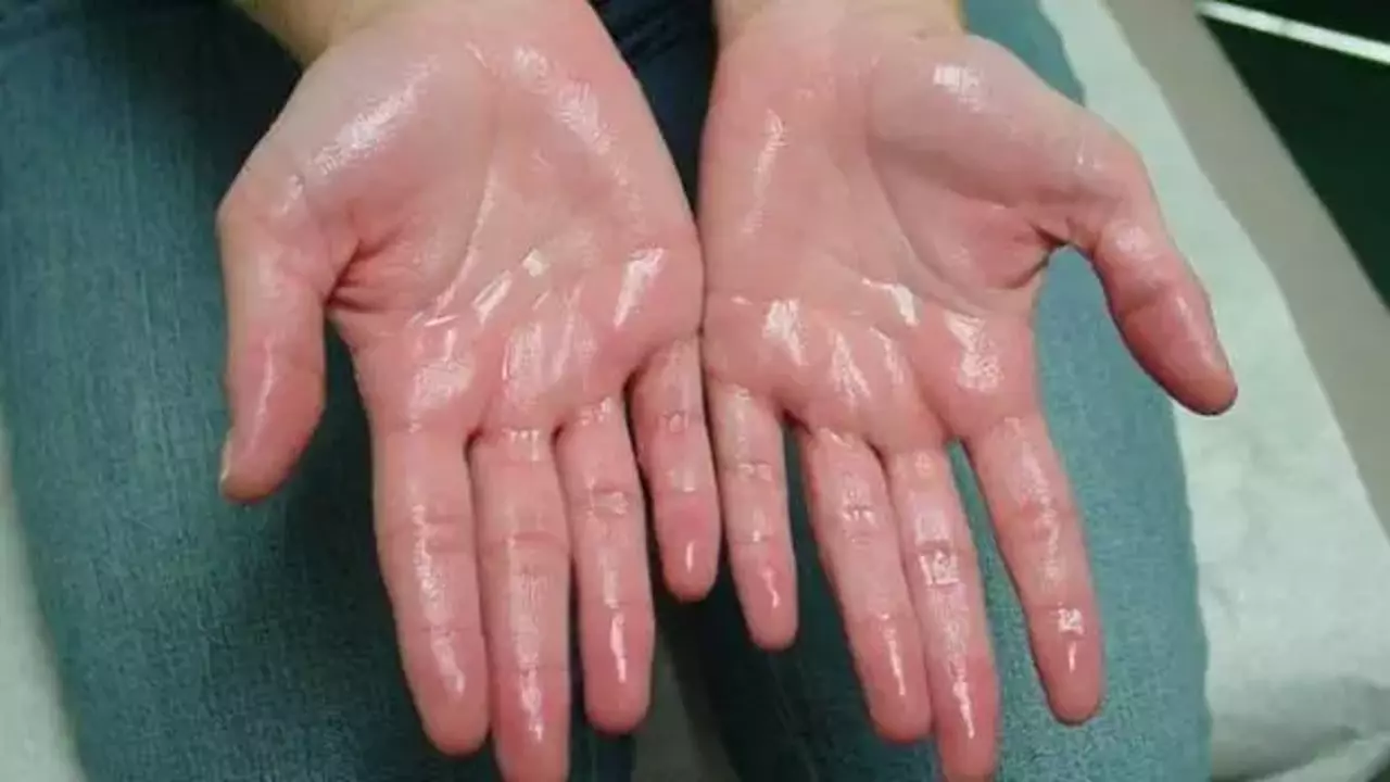 Avuç İçi Terlemesi Hangi Hastalığın İşareti Olabilir (1)-1