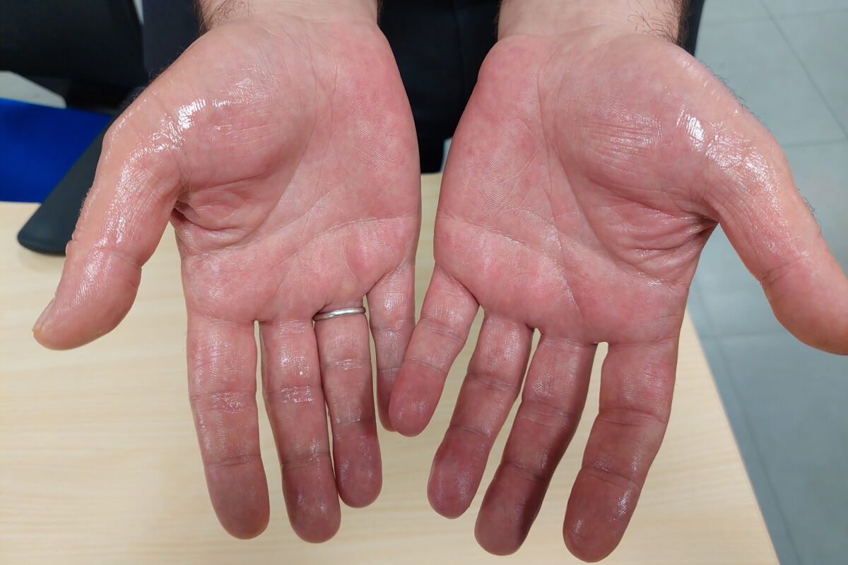Avuç İçi Terlemesi Hangi Hastalığın İşareti Olabilir (1)