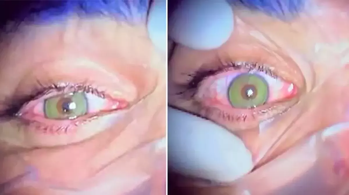 Göz Rengi Değiştirmek Mümkün Mü Göz Rengi Değiştirme Ameliyatı Nasıl Yapılıyor Ve Kalıcı Mı (4)