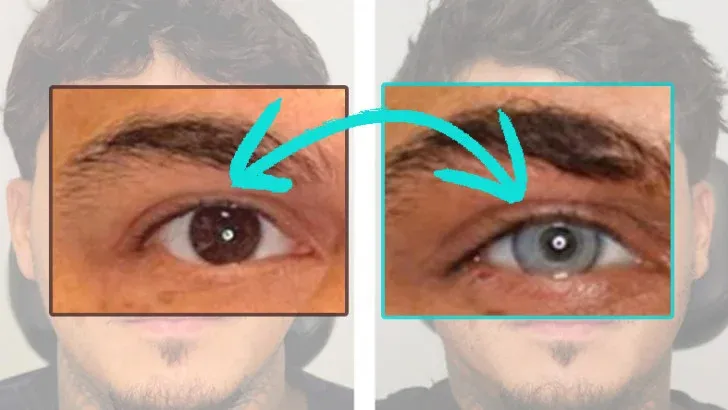 Göz Rengi Değiştirmek Mümkün Mü Göz Rengi Değiştirme Ameliyatı Nasıl Yapılıyor Ve Kalıcı Mı (5)
