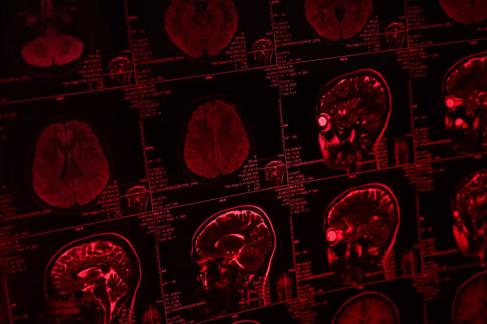 Kan Ver, Sonucu Öğren! Beyin Tümörünü Erken Yakalayan Yeni Test Umut Verdi (1)