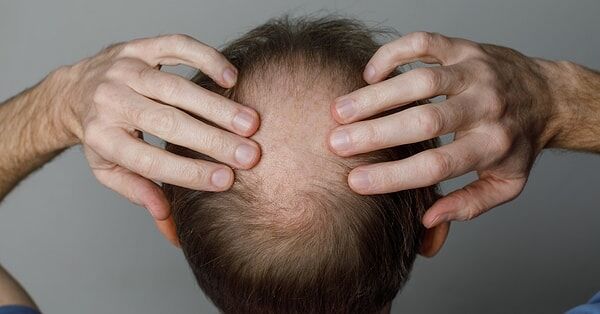 Saç Ekimi Tarih Mi Oluyor Bilim İnsanları Laboratuvarda Gerçek Saç Kökü Üretmeyi Başardı (2)