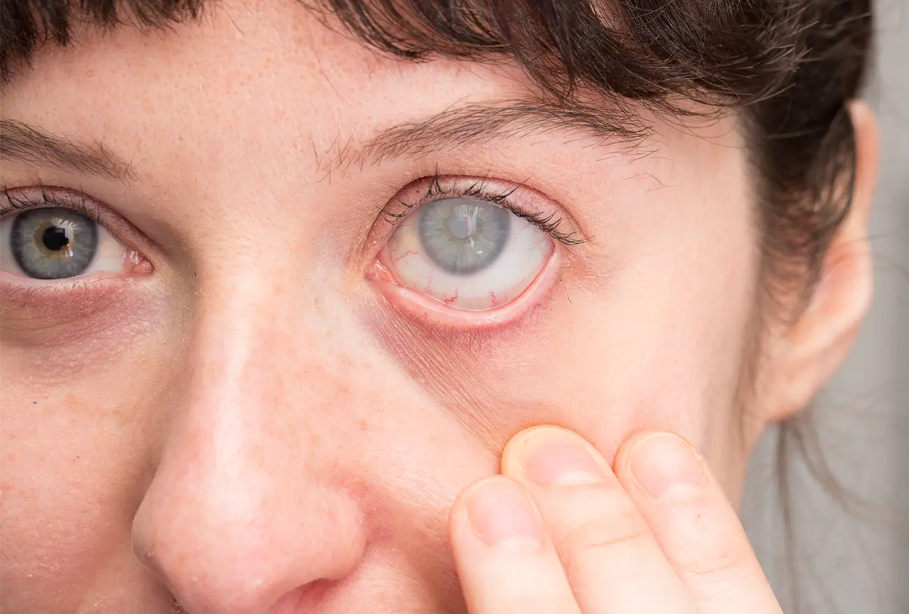 Sessizce Görme Kaybına Yol Açıyor! Glokom Nedir, Kimler Risk Altında Ve Nasıl Önlem Alınabilir (2)