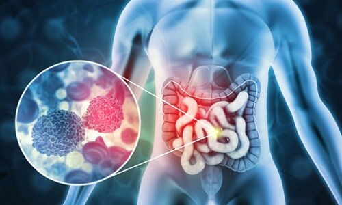 Tıpta Kolorektal Kanser (4)